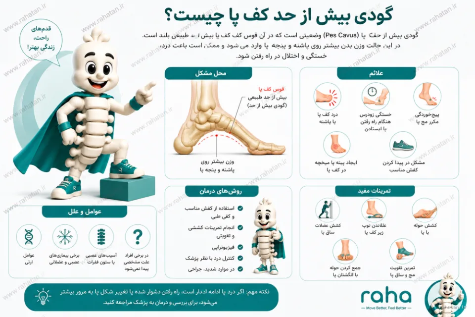 گودی بیش از حد کف پا | علائم، علل، روش‌های درمان و تمرینات اصلاحی